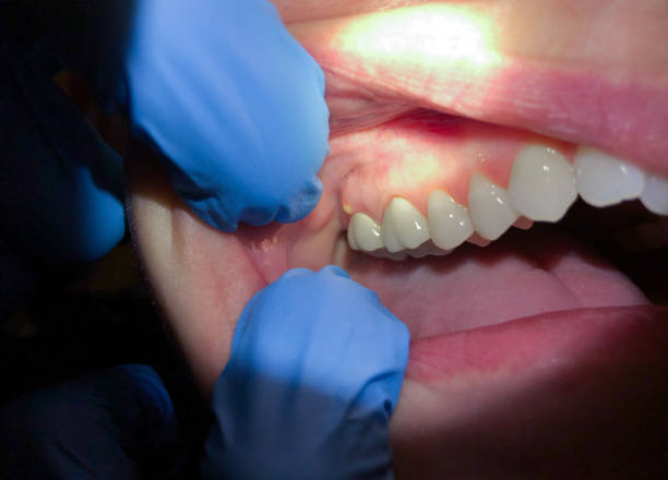 Best Knocked-Out Tooth Emergency  in Meyers, CA